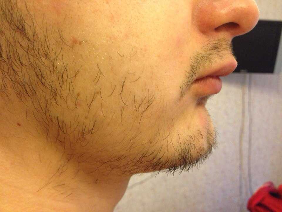 Почему быстро растут волосы на лице у мужчин после бритья