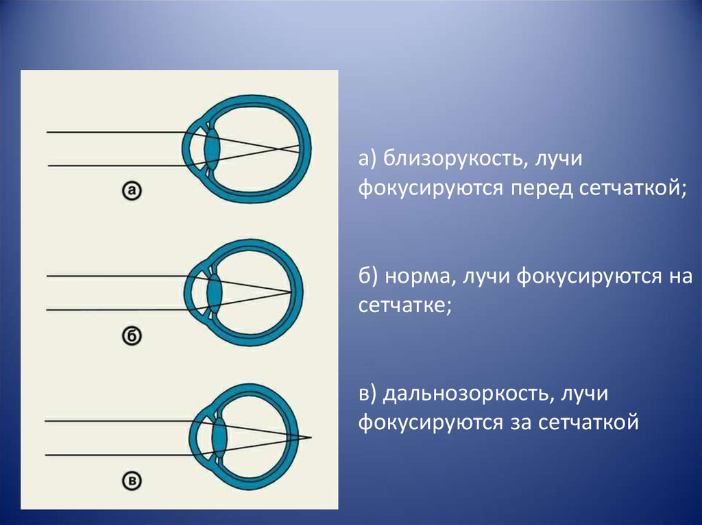 Рассмотрите рисунок сравните близорукость и дальнозоркость ответы занесите в таблицу