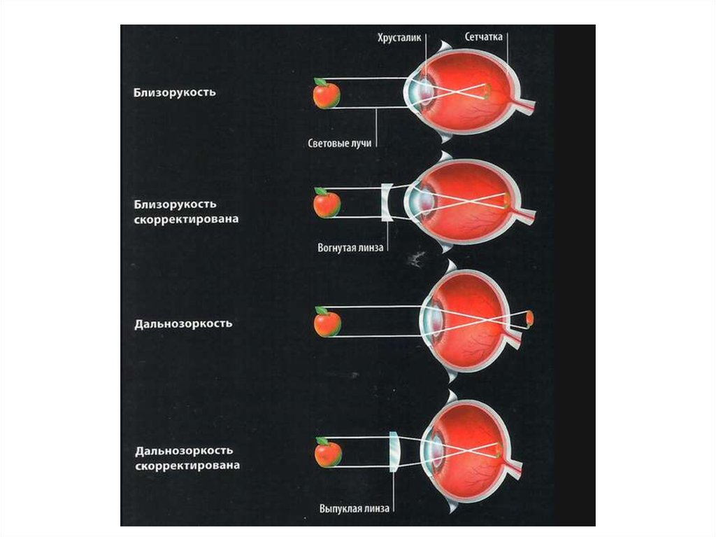 Дальнозоркость форма глазного яблока