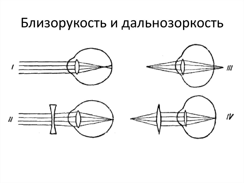 На рисунке представлены схемы хода лучей в глазу человека при дальнозоркости и близорукости