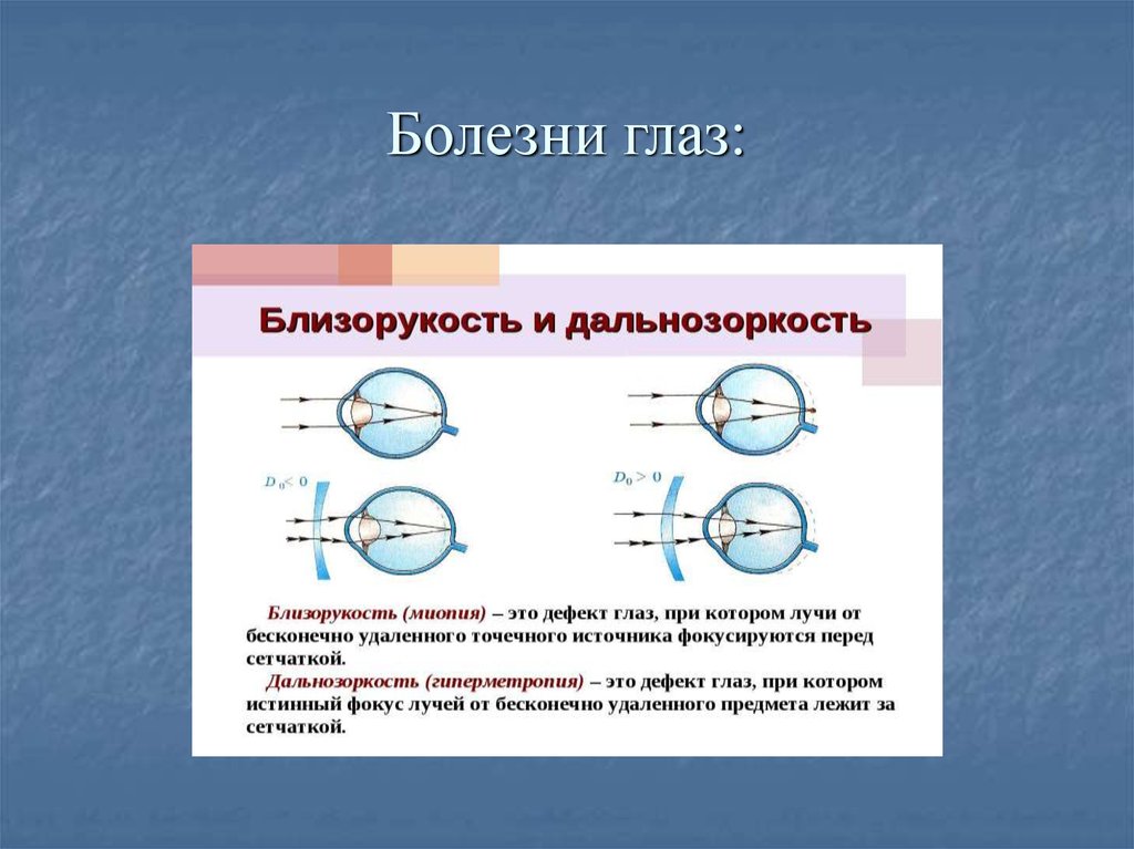 Дополните предложения изображение в близоруком глазу фокусируется