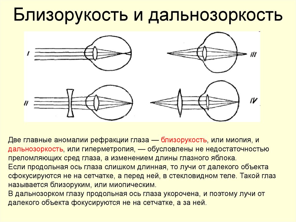 Близорукость схема глаза