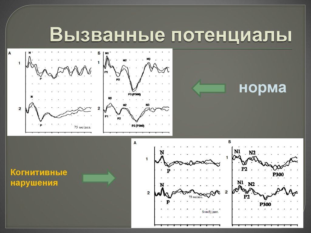 Зрительные вызванные потенциалы