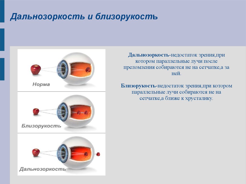 Дальнозоркость. Близорукость и дальнозоркость. Нормальное зрение близорукость дальнозоркость. Близорукость недостаток зрения при котором параллельные лучи. Норма близорукость дальнозоркость.