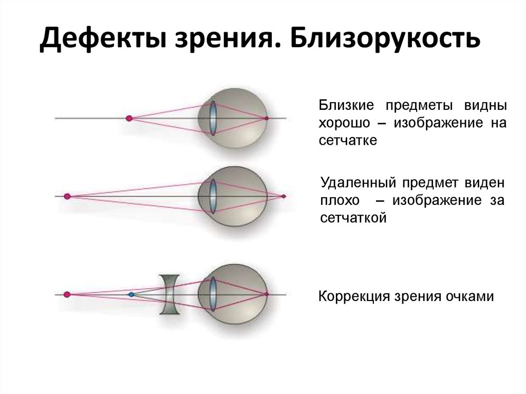 На рисунке 9 приведены схемы хода лучей в глазу при близорукости и дальнозоркости