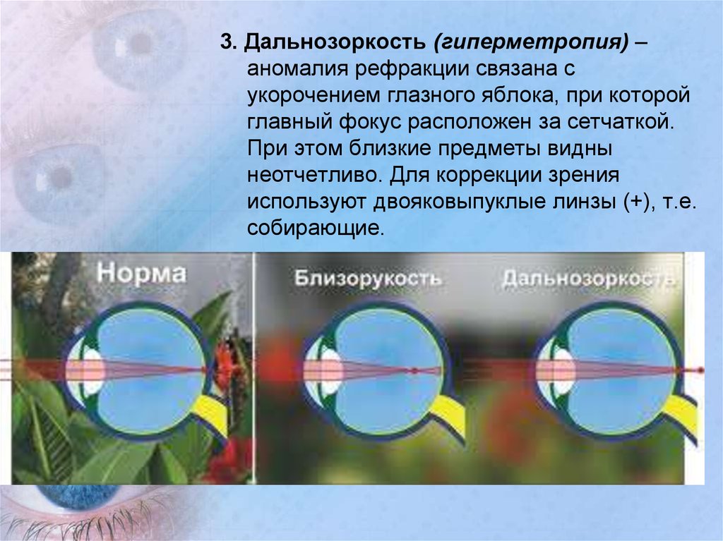 Дальнозоркость форма глазного яблока