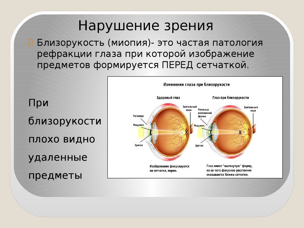 Миопия сетчатки. Зрительный анализатор строение и функции. Изменения при близорукости на сетчатке. При миопии изображение фокусируется. Рефракция глаза при миопии.