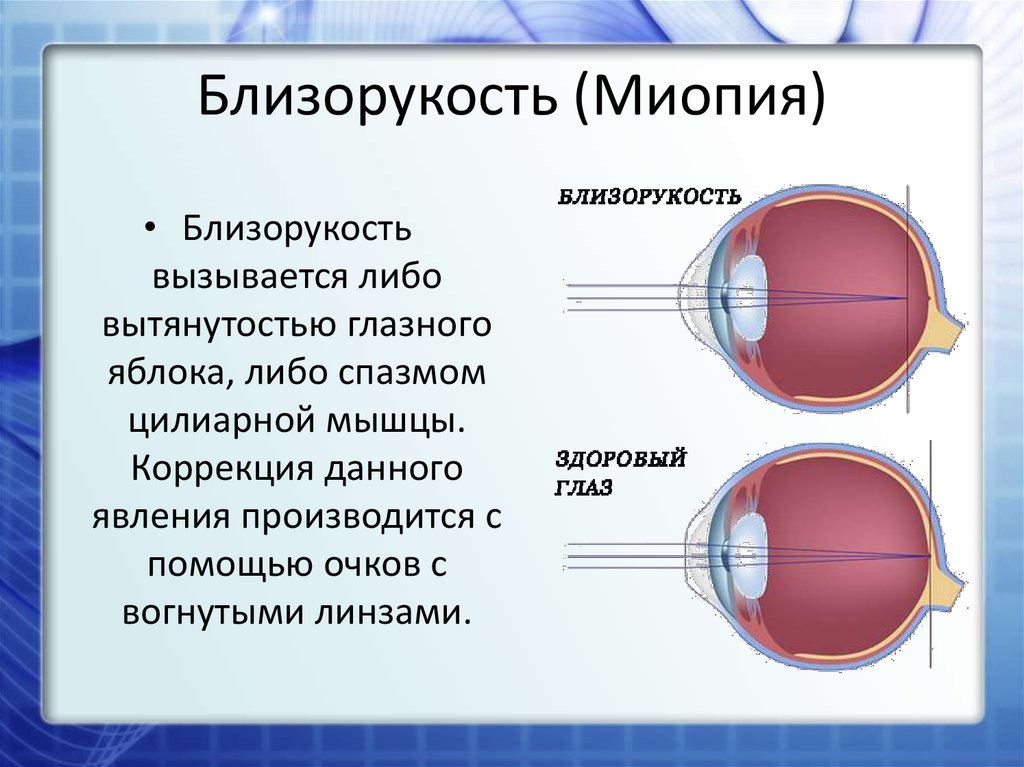 Миопия астигматизм глаз. Миопия. Близорукость миопия. Близорукость глазное яблоко.