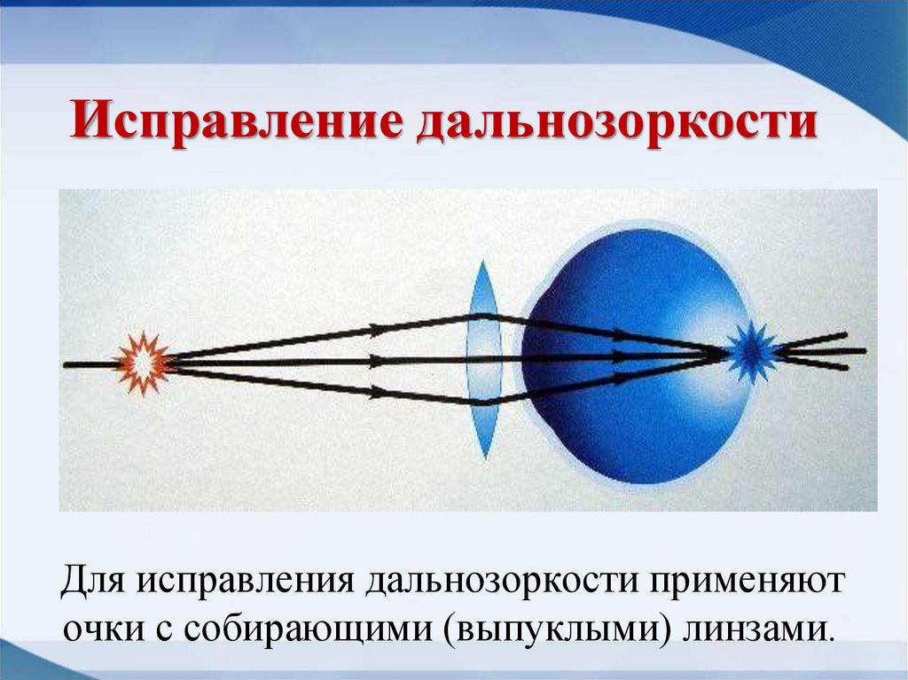 Где формируется изображение при близорукости