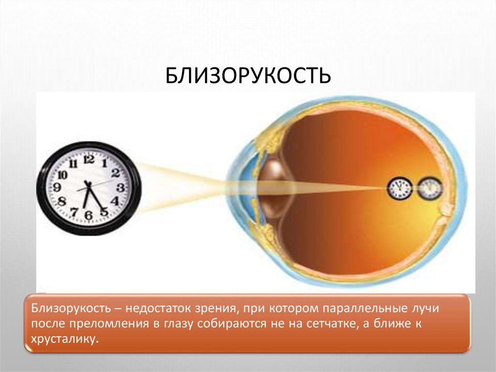 Причины близорукости. Оптическая система глаза при близорукости. Преломляющая система глаза. Причины миопии. Недостатки оптической системы глаза и их устранение.