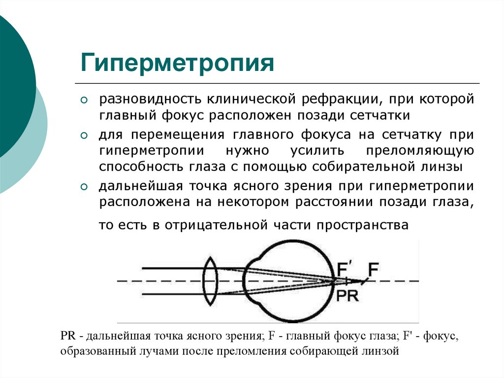 Где возникает изображение при близорукости