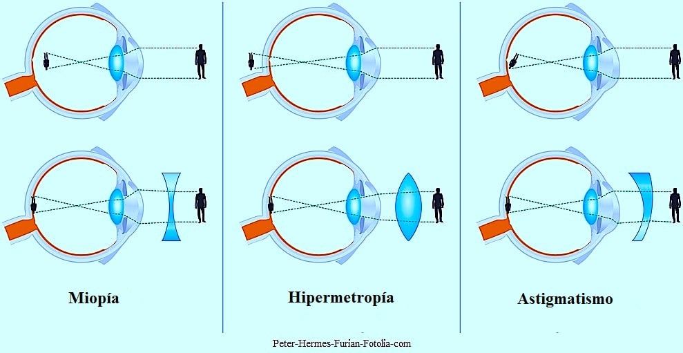 Коррекция зрения с помощью линз. Линзы при миопии и гиперметропии. Очки ( схемы : близорукость и дальнозоркость). Линзы форма для дальнозорких и близоруких. Близорукость и дальнозоркость линзы.