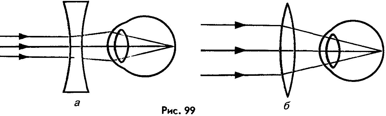 Схема хода лучей при близорукости и дальнозоркости