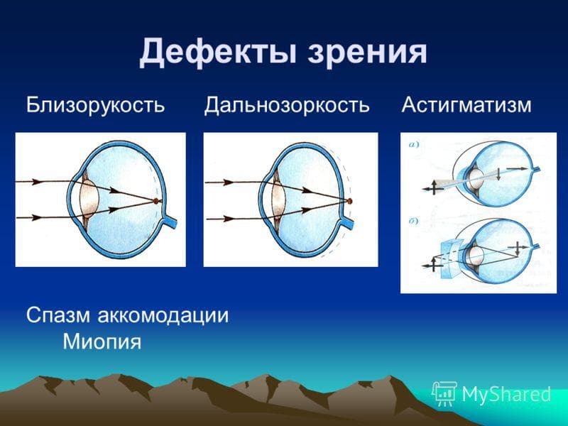 Дефекты зрения проект