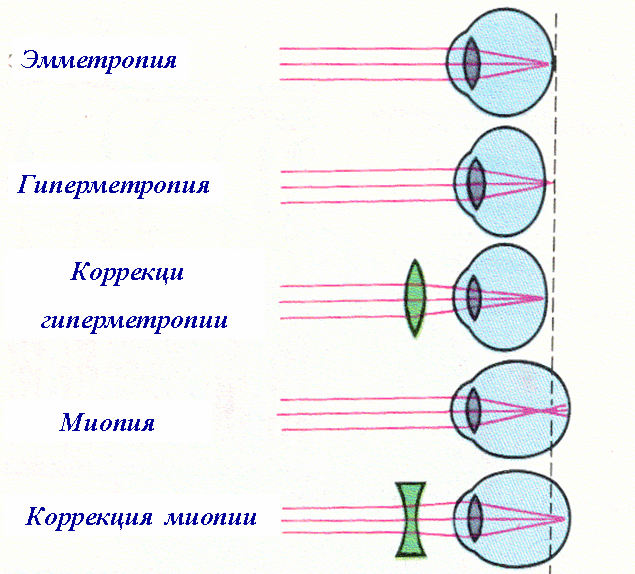 Схема дальнозоркости глаза