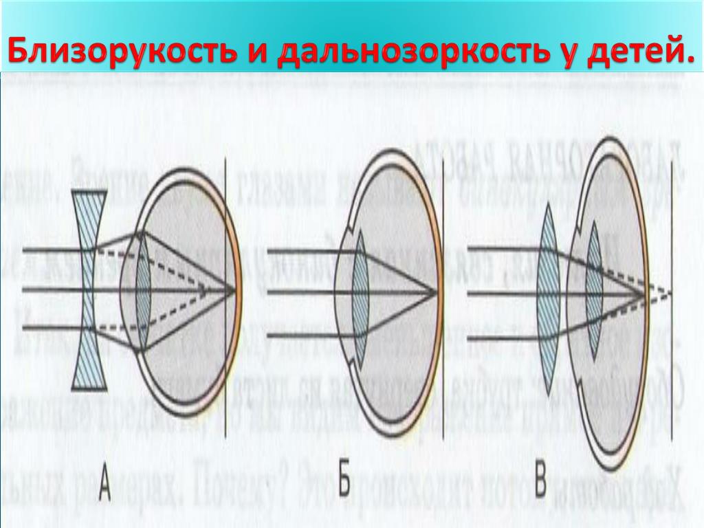 Дальнозоркость у детей