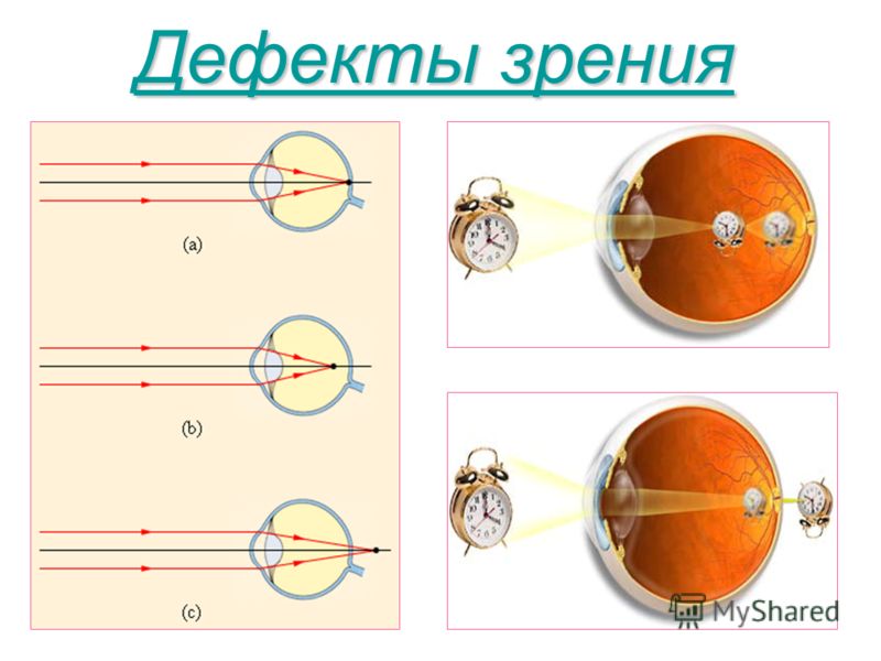 Различие зрения и. Дефекты зрения. Глаз дефект зрения. Дефекты зрения и их коррекция. Дефекты зрения физика.