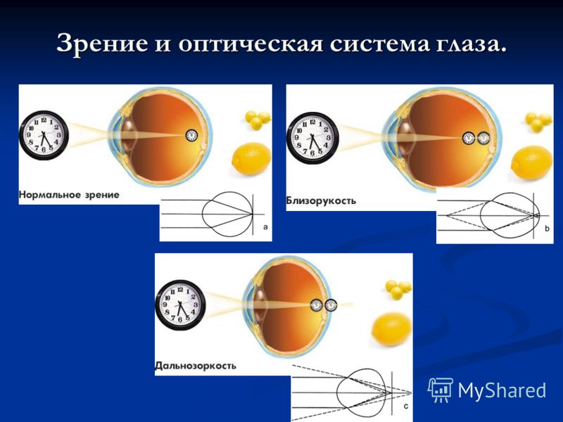 Дальнозоркость это плюс. Оптическая система глаза близорукость. Оптическая система глаза дальнозоркость. Нормальное зрение оптическая система. Нормальное зрение и близорукость.