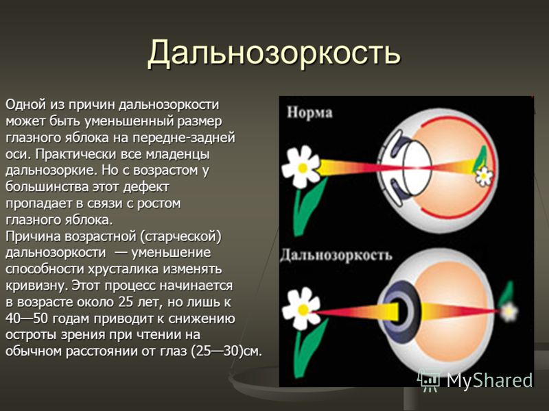 При дальнозоркости изображение возникает