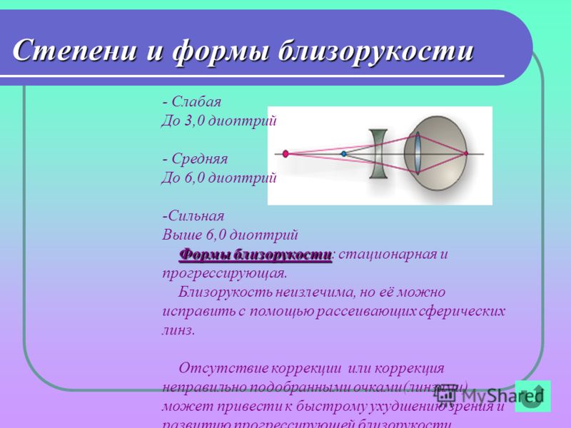 Диоптрия это. Прогрессирующая миопия форма. Близорукость от 6 диоптрий. Миопия 0.6. Близорукость (миопия) до 3 дптр..