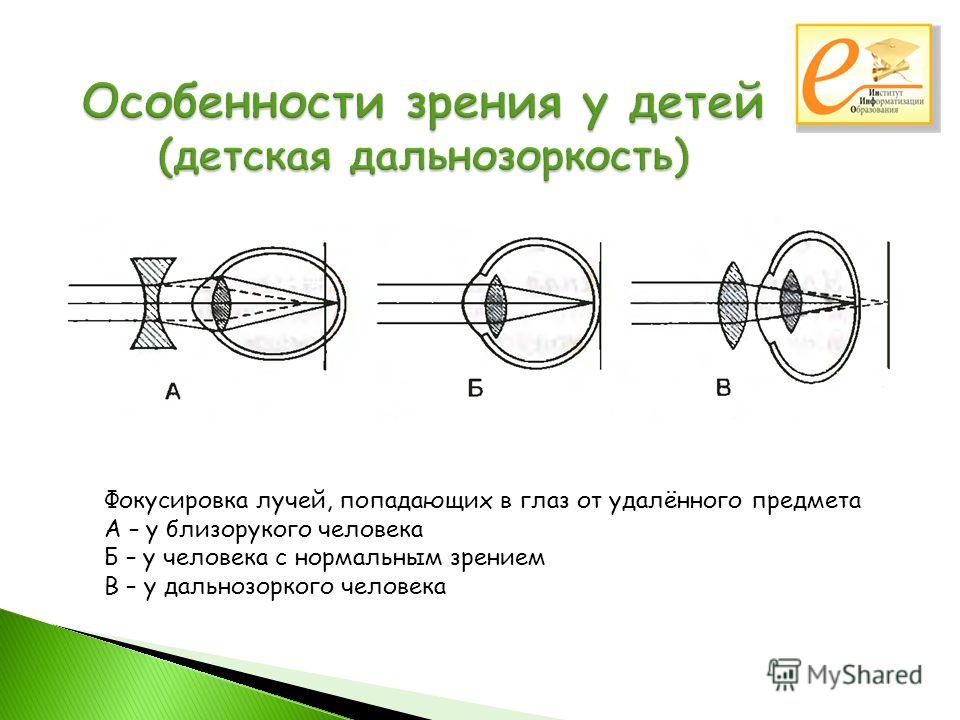 Фокусировка изображения у людей с нормальным. Фокусировка лучей. Фокусировка зрения у дальнозорких. Фокусировка лучей попадающих в глаз. Ход лучей в нормальном близоруком дальнозорком глазе.