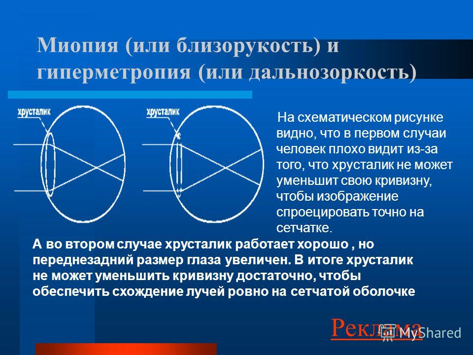 Астигматизм оптической системы. Миопия гиперметропия астигматизм. Осевая гиперметропия. Гиперметропия классификация. Гиперметропия степени классификация.