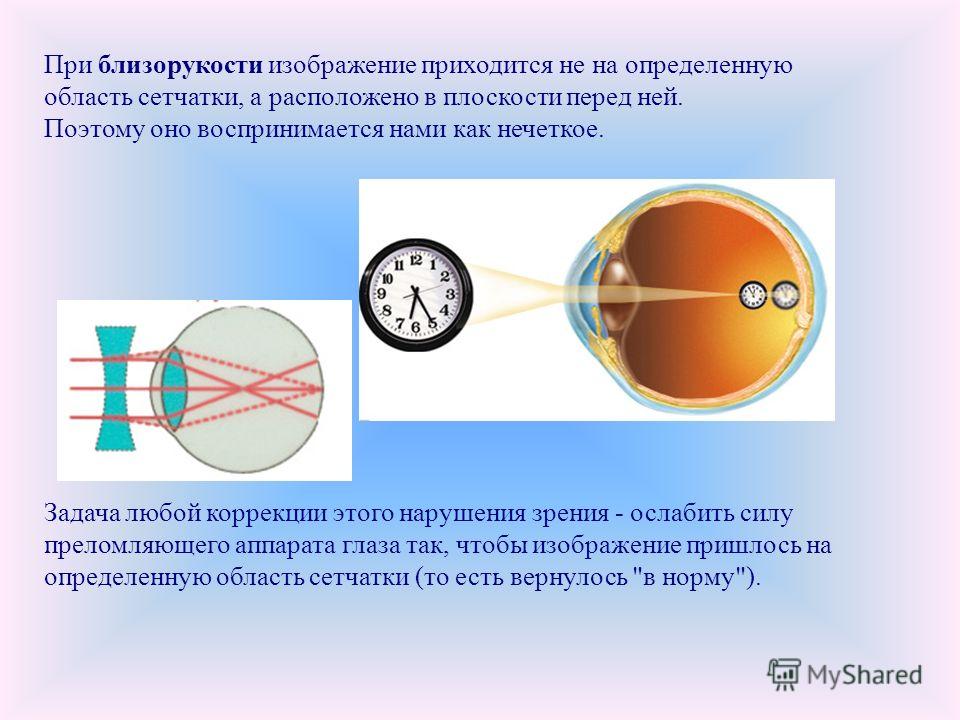 Близорукость форумы