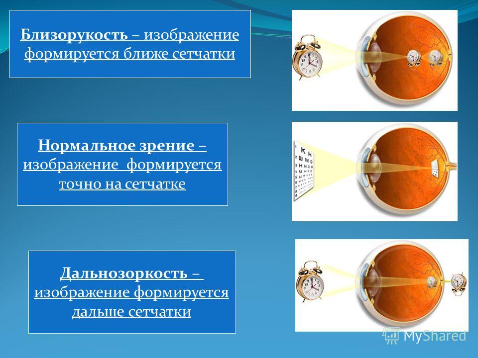 Дополните предложение изображение в близоруком глазу фокусируется сетчатки а в дальнозорком