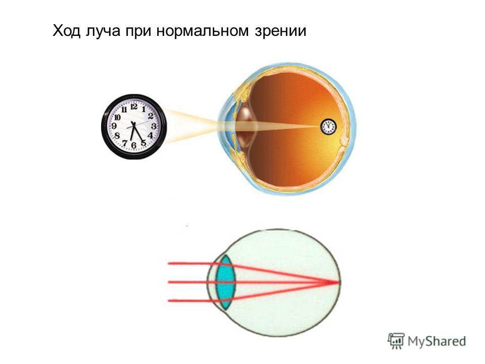 Дальнозоркость рисунок глаза