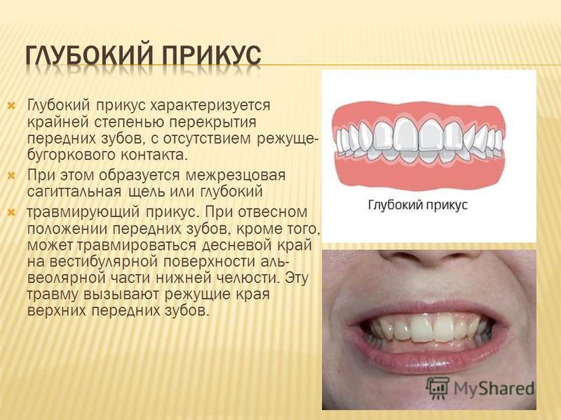 Зубы при закрытом рте. Ортогнатический прикус с глубоким резцовым перекрытием. Глубокий прикус передние зубы.