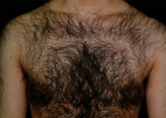 От чего у мужчин начинают расти на груди волосы