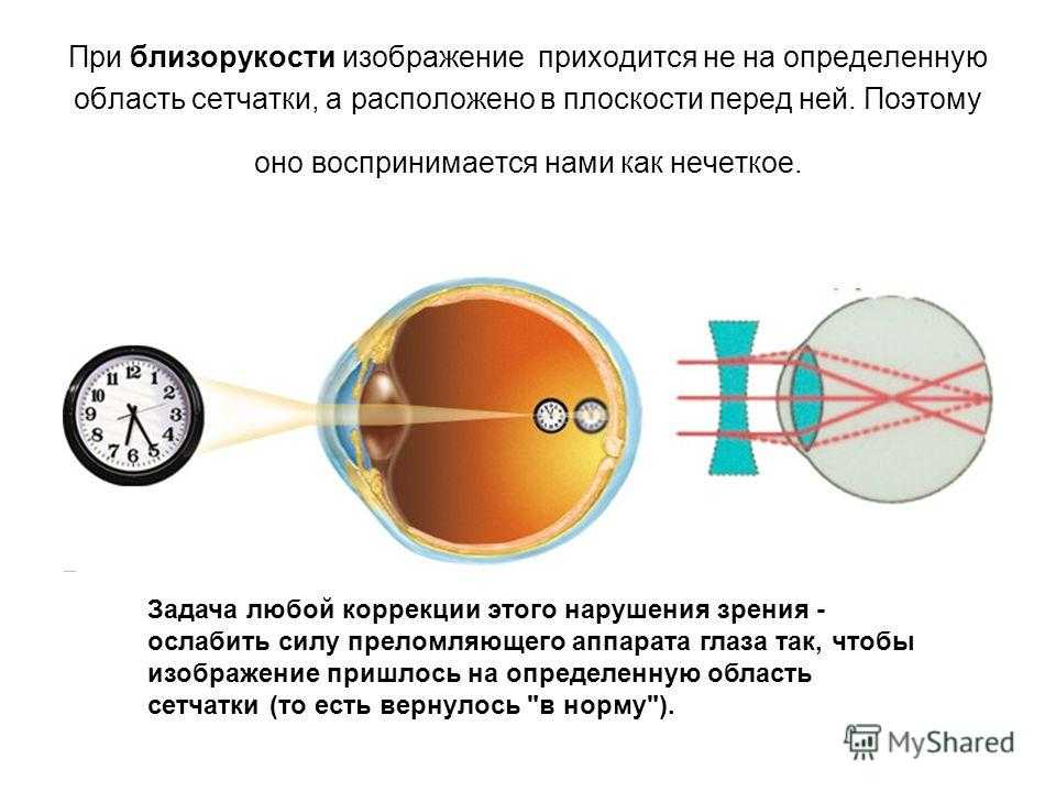 Зрение возникло. Близорукость (истинная и ложная формы патологии). Зрение близорукость. Миопия или близорукость. Близорукость развивается при.