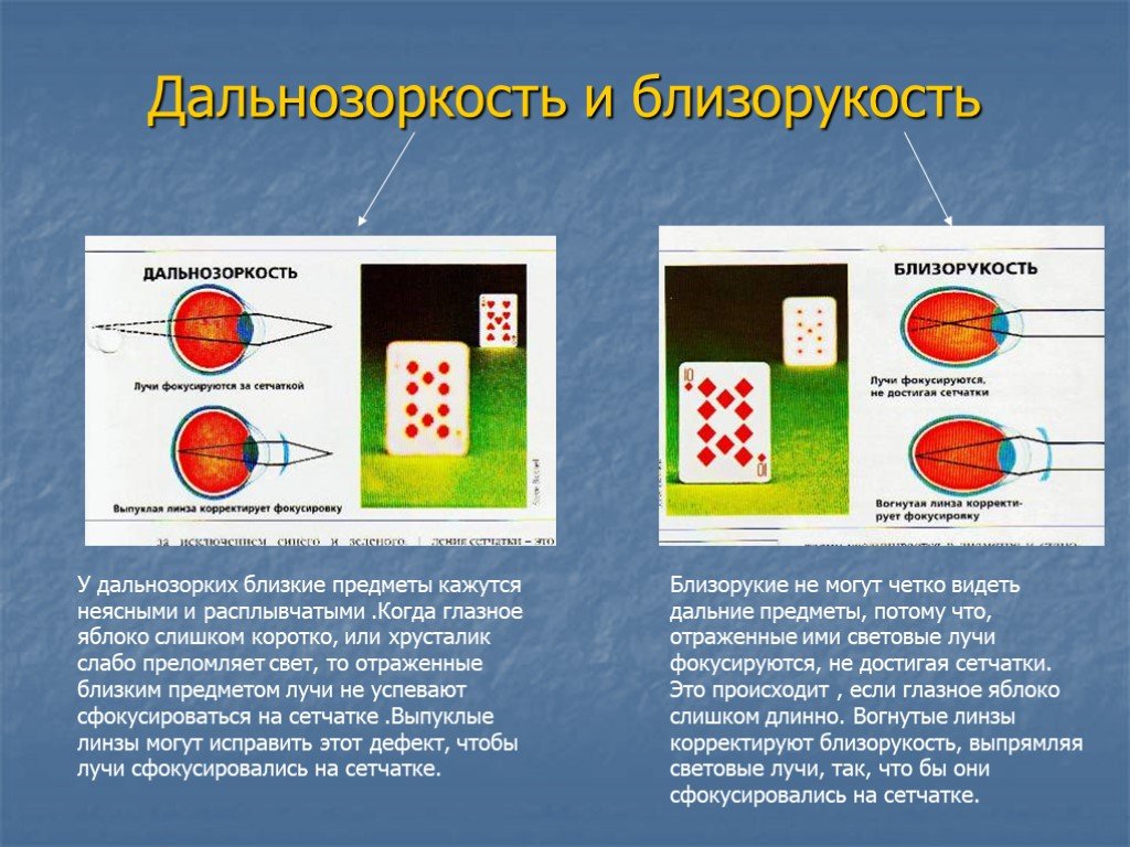 Презентация по биологии на тему близорукость и дальнозоркость