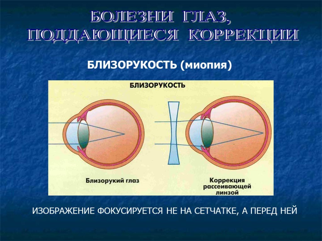 Что такое близорукость в какой части глаза фокусируется изображение у близорукого человека чем