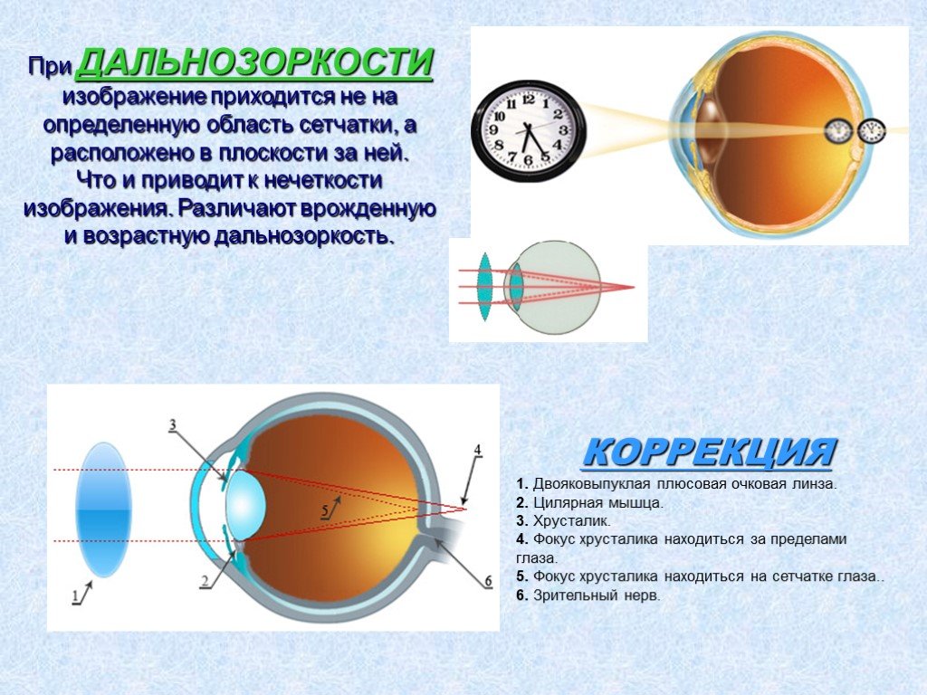 Причины возникновения дальнозоркости. Гиперметропия слабой степени 52.0. Гиперметропия 2 степени. Гиперметропия глаза что это такое у детей. Гиперметропия средней степени обоих глаз.