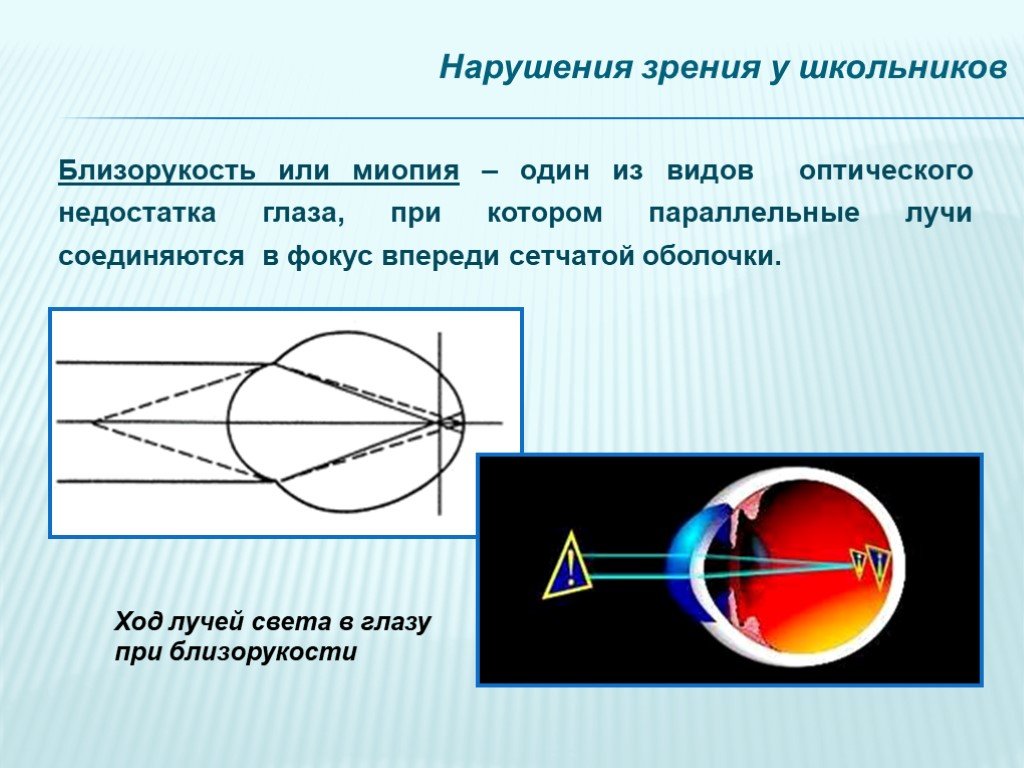 Лучи зрения. Близорукость схема лучей. Нарушение зрения близорукость. Ход лучей в глазу при близорукости. Оптические нарушения зрения.