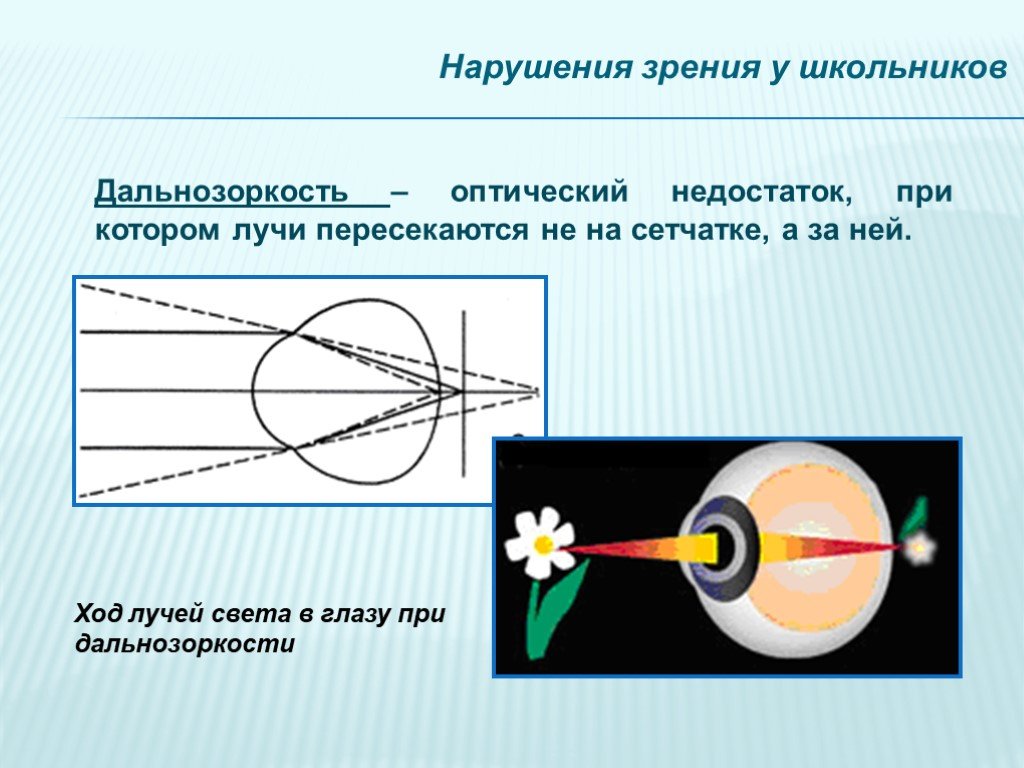 Какая из схем хода лучей в глазу человека соответствует случаю дальнозоркости глаза с очками