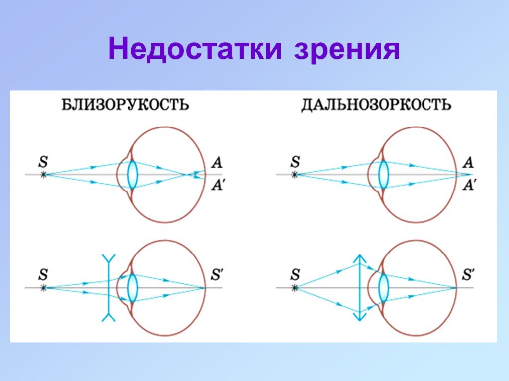 Близорукость дальнозоркость астигматизм презентация