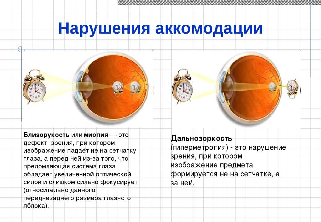 При дальнозоркости изображение предмета получается