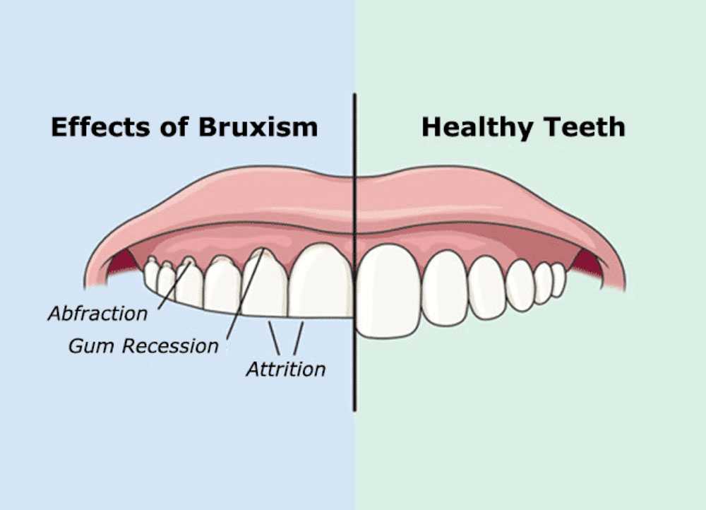 Почему ночью скрипят зубами взрослые. Бруксизм в стоматологии.