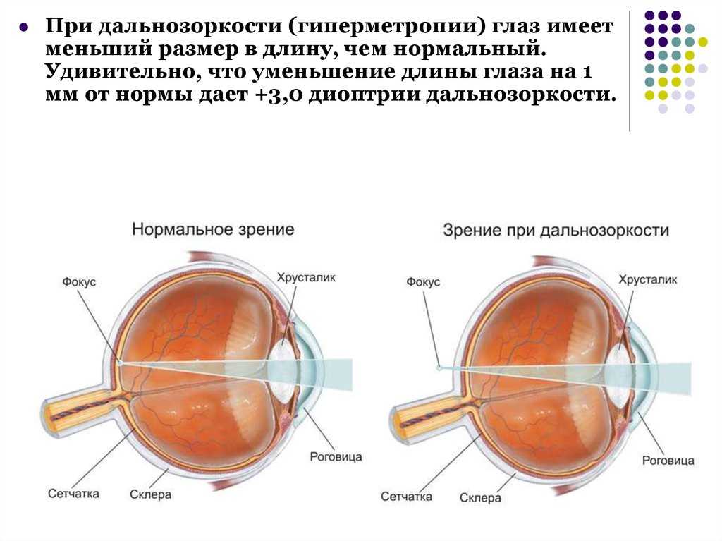 Гиперметропия средней степени глаза. Астигматизм схема преломления лучей. Сетчатка при близорукости. Стигматизм. Физиологический астигматизм.
