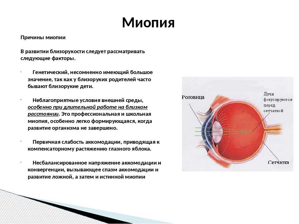 Заболевание близорукости. Миопия 1,0 степень. Миопия слабой степени правого глаза у взрослого. Миопия слабой степени обоих глаз. Миопия средней степени обоих глаз у ребенка 1 степени.