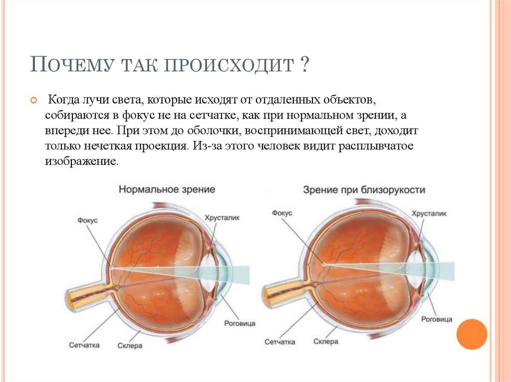 Миопия слабой степени обоих глаз. Миопия сетчатки глаза. Близорукость хрусталик. Заболевания глаз близорукость. Фокус при миопии.