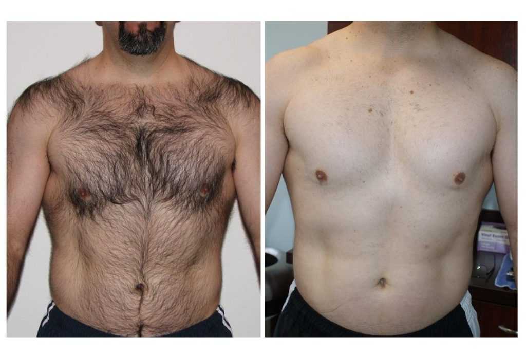 Почему у мужчин большие груди. Мужская депиляция. Мужская эпиляция до и после. Волосы на грудине у мужчин.