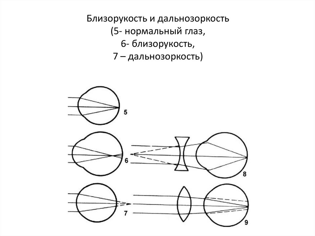 Близорукость дальнозоркость схема