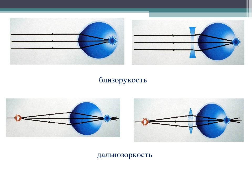 Близорукость и дальнозоркость картинки