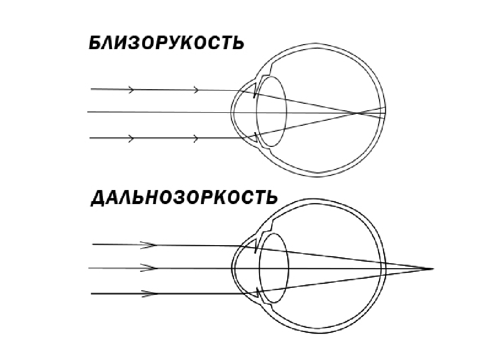 Нормальный глаз схема. Близорукость и дальнозоркость схема физика. Схема хода световых лучей при близорукости. Гиперметропия схема глаза. Близорукость и дальнозоркость схема глаза.