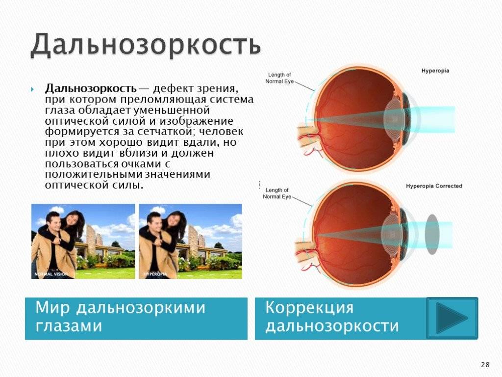 Презентация про близорукость