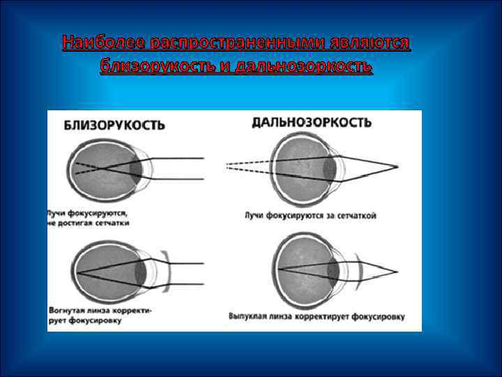 Близорукость дальнозоркость астигматизм презентация