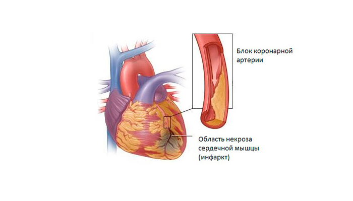 Некроз сердечной мышцы в следствии постоянного употребления пива